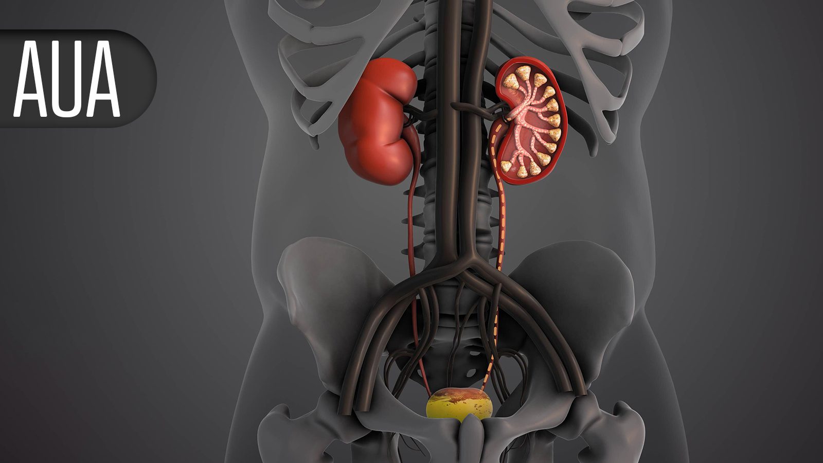 Exceptional Response Rates in Non-Responsive, Non-Muscle Invasive Bladder Cancer